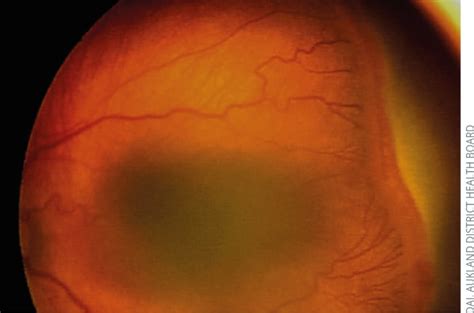 Frühgeborenen Retinopathie ROP Ophtha ch