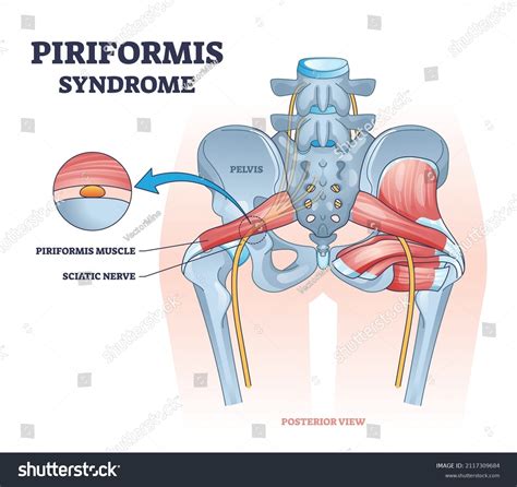 Piriformis Syndrome Sciatic Nerve Compression Pain Stock Vector ...