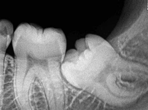 CBCT Scan For Impacted Tooth Oral Radiology Toronto