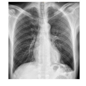 Frontal Chest X Ray Emergucate