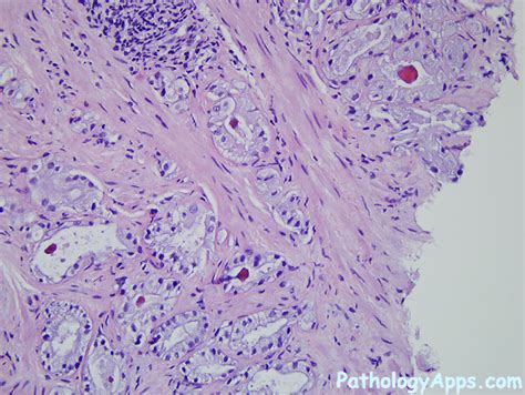 prostate adenocarcinoma pathology