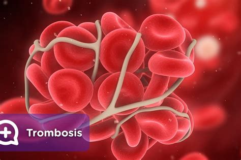 Trombose causas sintomas diagnóstico y tratamiento