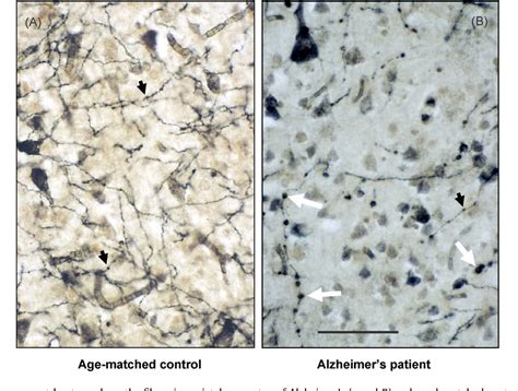 Figure 1 from The basal forebrain cholinergic system in aging and dementia. Rescuing cholinergic ...