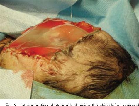 Figure 6 From Management Of Large Scalp And Skull Defects In A Severe