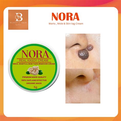 Nora Kasoy Cream Remover G Mole Remover Warts Remover Cream Skin Tag