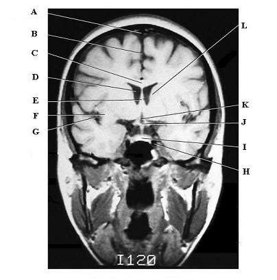 Brain Sectional Anatomy Diagram Quizlet