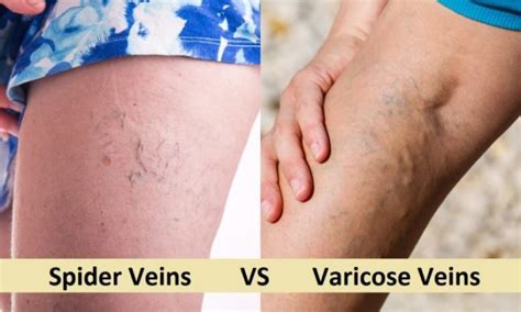 Spider And Varicose Veins Treatment Kangaroo Point Medical Centre