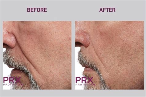 Prx Skin Tightening No Peel Chemical Peel Rejuve Medspa Newcastle