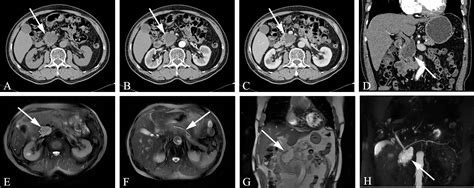 Frontiers Cystic Neoplasms Of The Pancreas Differential Diagnosis