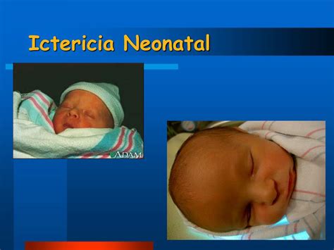 Ppt Ictericia Neonatal Aspectos Pr Cticos Powerpoint Presentation | The ...