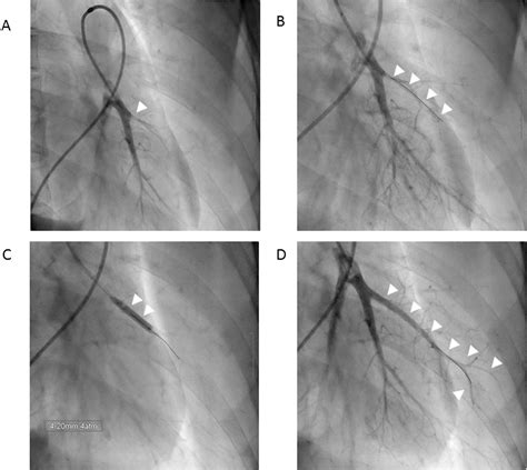 Efficacy And Safety Of Balloon Pulmonary Angioplasty For Chronic