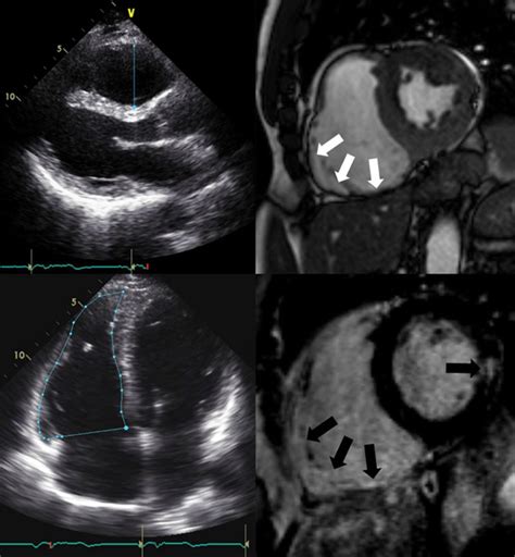 Arrhythmogenic Right Ventricular Cardiomyopathy Circulation