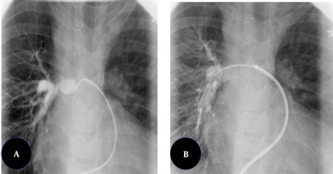 A, Severe isolated stenosis of the right pulmonary artery in a ...