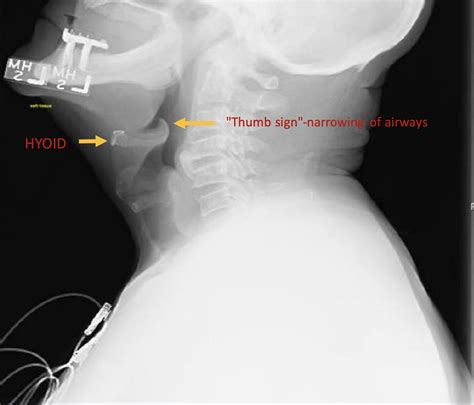 Swollen Epiglottis Treatment