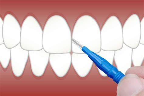 La Importancia De La Higiene Interproximal Clnica Dental Davos