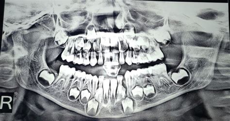 Pre Operative Orthopantomogram Showing A Radiolucent Line Between