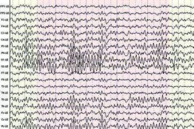 Quantitative EEG Brain Mapping Treatments | Brain Health Clinic