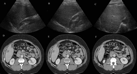 Ultrasound Hepatitis - Radiology Imaging