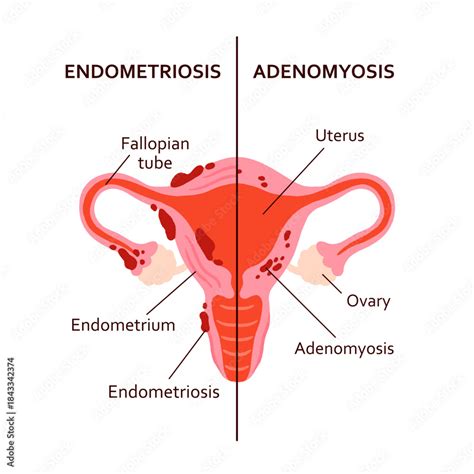 endometriosis  adenomyosis comparison diagram split uterus vector