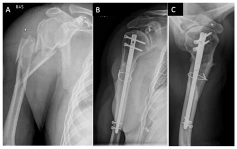 Medicina Free Full Text Combined Humeral Head And Shaft Fractures