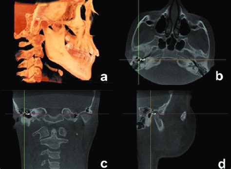 Right porion cephalometric landmark (PoR) identified in the 3D (A),... | Download Scientific Diagram