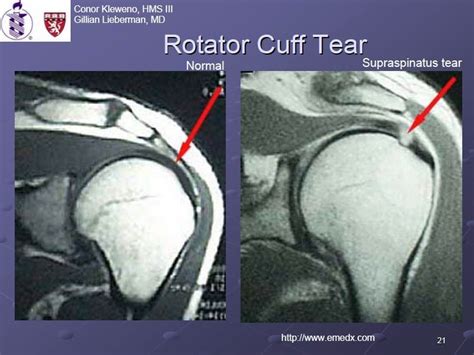 Rotator Cuff Tear Vs Normal Frontline Ministries International