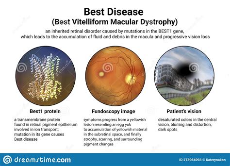 Best Vitelliform Macular Dystrophy 3d Illustration Stock Illustration Illustration Of