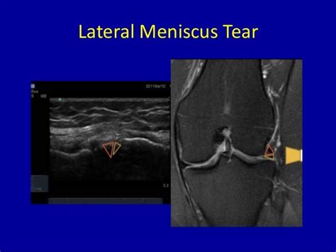 Imaging Of Knee By Mr And Usg