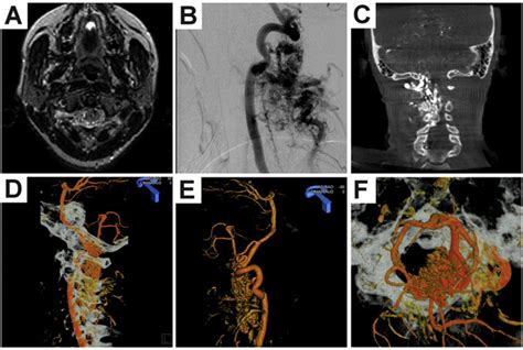 Stereotactic Radiosurgery For Intramedullary Spinal Arteriovenous Malformations Journal Of