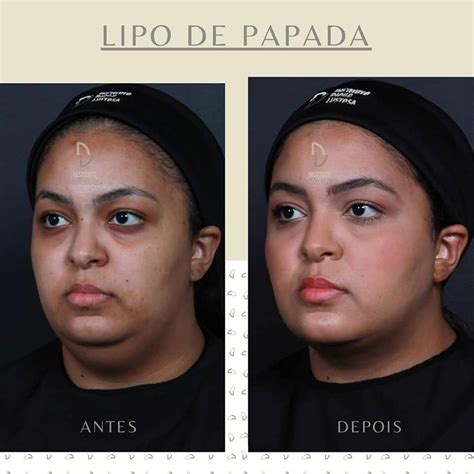 Lipoaspira O De Papada Entenda O Que E Como Funciona Oc Clinic