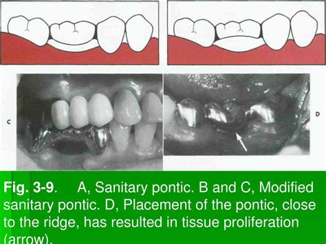 dental bridges pontics clinical  technological aspects