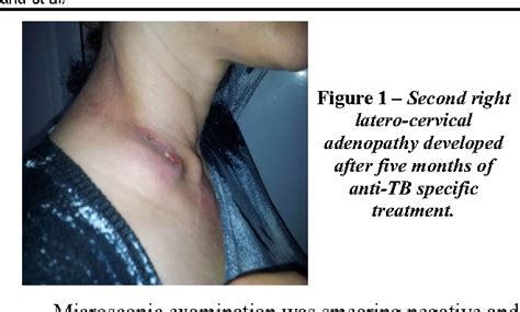 Figure 1 From Tuberculosis Mesenteric Adenopathy And Polyserositis Semantic Scholar