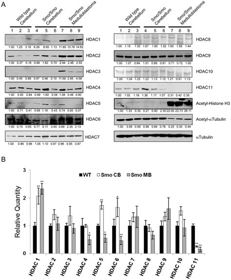 HDAC Protein And MRNA Levels In Medulloblastoma A Immunoblot Of HDACs