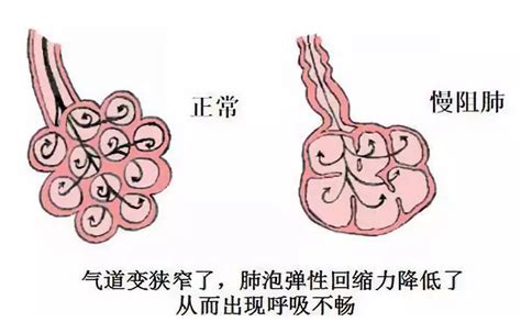 慢阻肺的早期症状 凤凰网