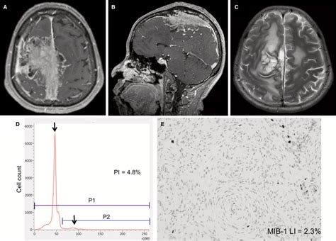 Illustrative Case 1 Preoperative Axial A And Sagittal B