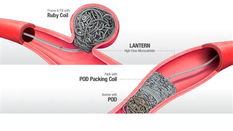 Embolisation System – Vascupedia