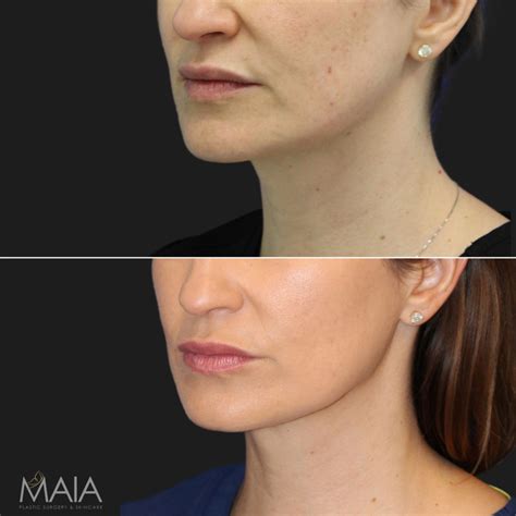 Washington Dc Neck Botox Before And After Pictures Tysons Corner