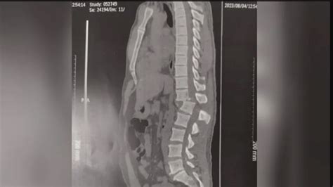 Raio X Mostra Lesão Em Coluna De Homem Atingido Em Academia No Ce