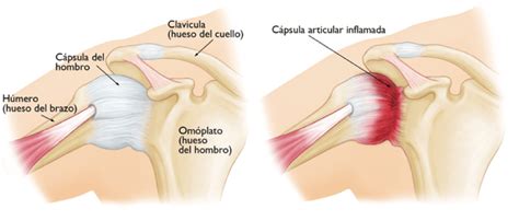 Capsulitis adhesiva Tratamiento y diagnóstico