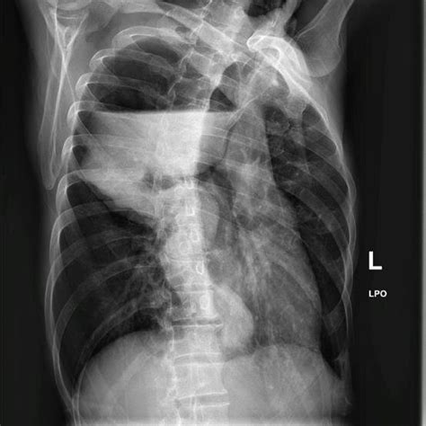 Chest X Ray With Contrast Ap Position Download Scientific Diagram