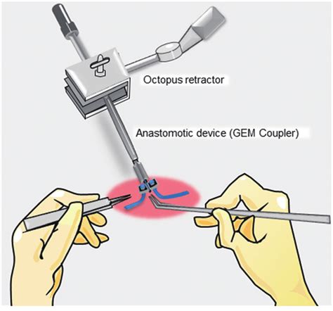Schematic illustration of the microsurgical procedures. Certain tip ...