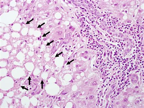 Acute Hepatic Necrosis 2023