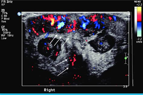 Scrotal Color Doppler Ultrasound Showing Subcutaneous Fat Layers