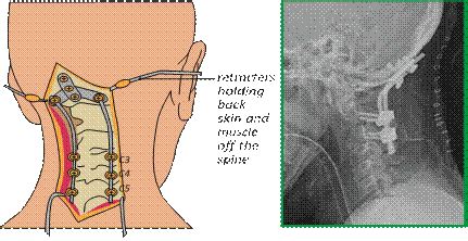 Cervical Stenosis And Myelopathy Surgical Options Spine And Brain