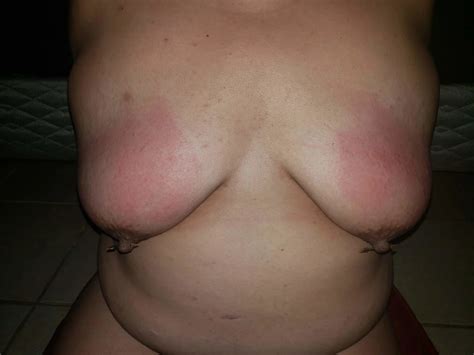 Bruises Nude Pics XHamster