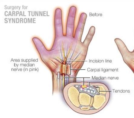 Carpal Tunnel Syndrome Sierra Pacific Orthopedics