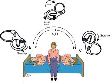 BPPV -- Semont maneuver