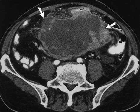 Mesenteric Neoplasms Ct Appearances Of Primary And Secondary Tumors And Differential Diagnosis