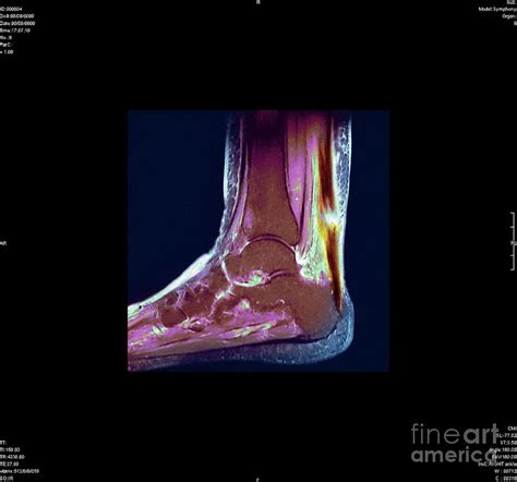 Torn Achilles Tendon Photograph by Gustoimages/science Photo Library