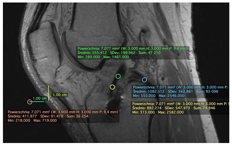 Applied Sciences Free Full Text Evaluation Of Acl Graft Remodeling